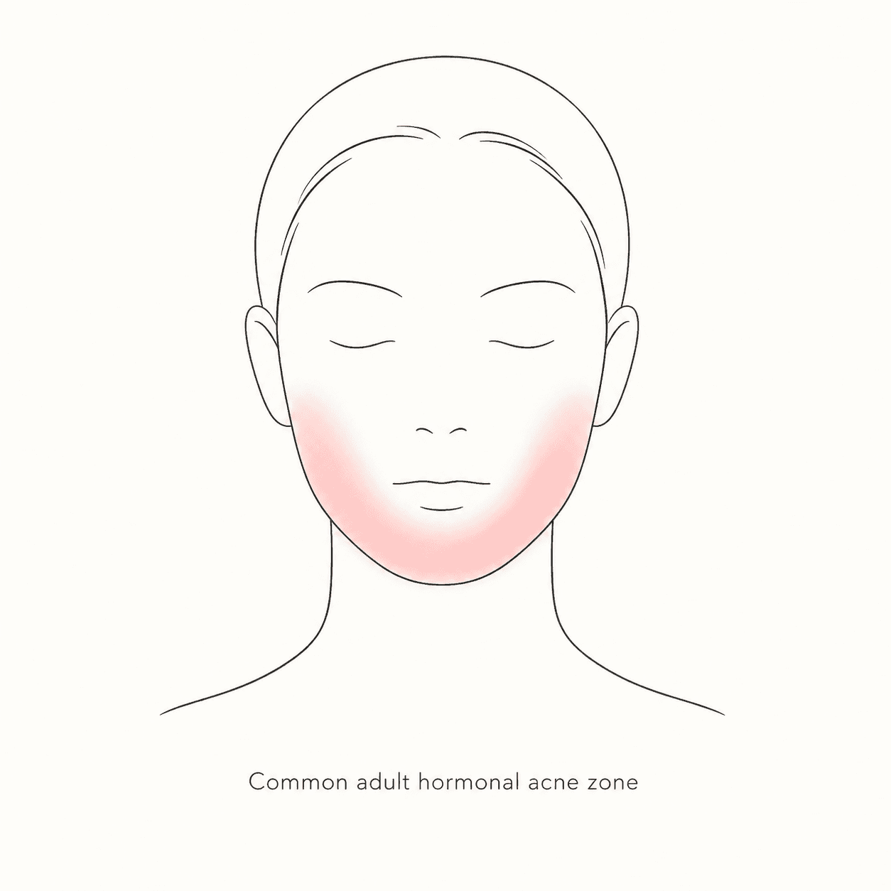 Minimalist medical illustration of a front-facing head outline with the jaw, chin, and lower cheek area highlighted as the common adult hormonal acne zone